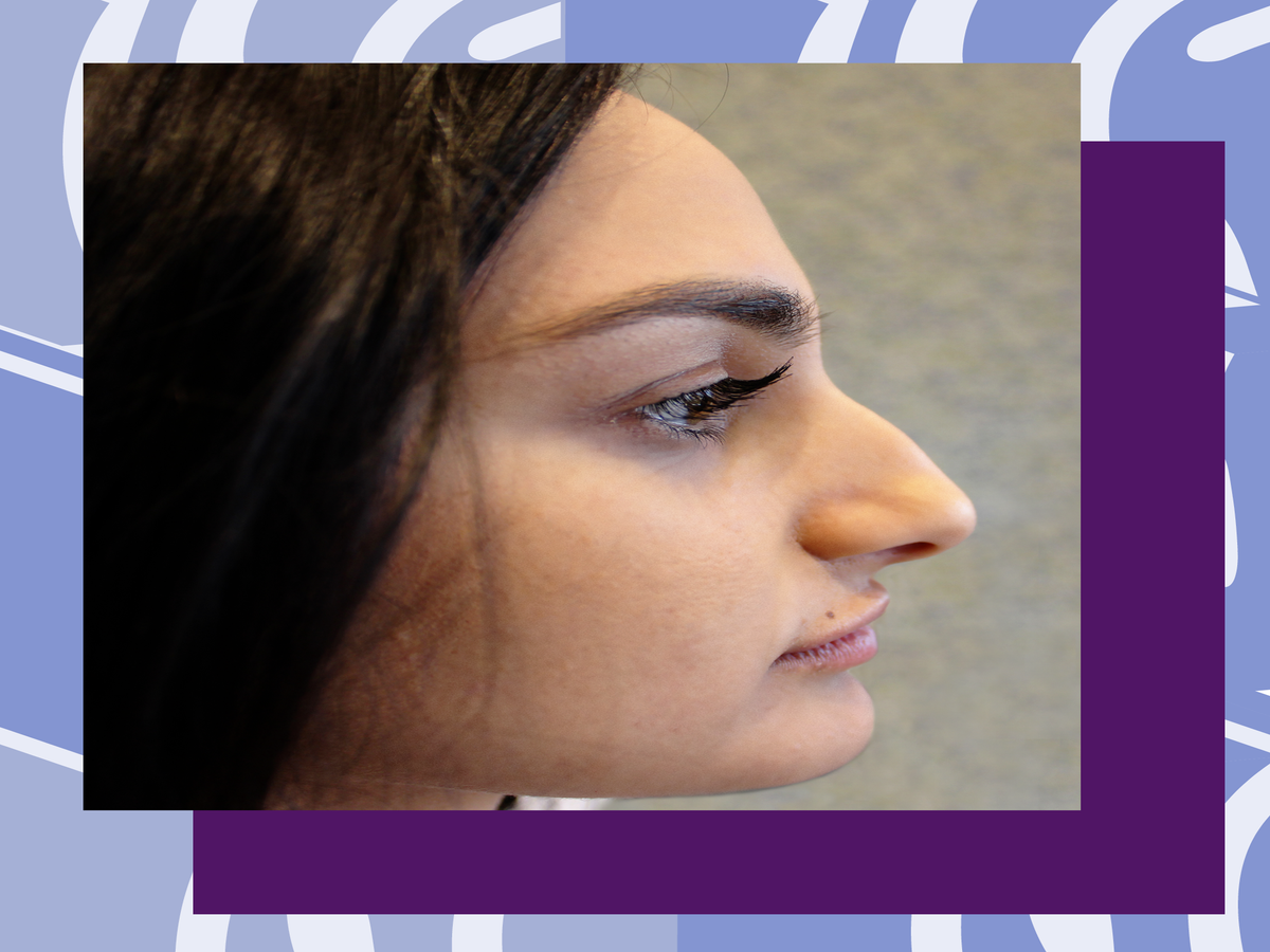 I Got A Nose Job In 5 Minutes -- & It Didn't Hurt At All