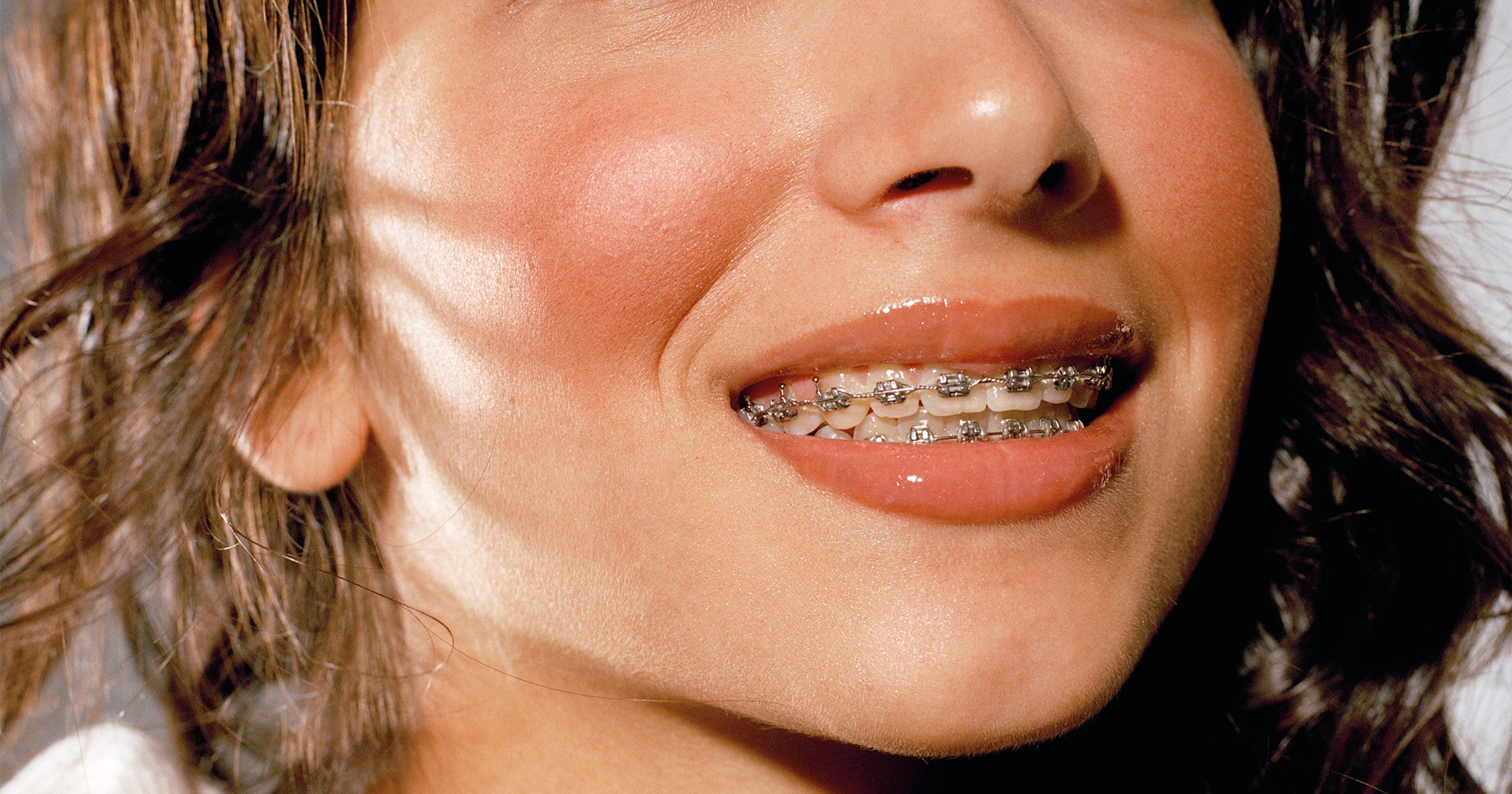 Dental Braces Puncture Woman Intestine Inside 10 Years