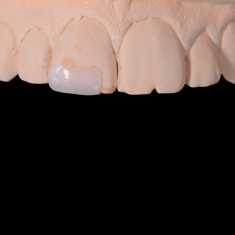 Repair Chipped Teeth With Bonding