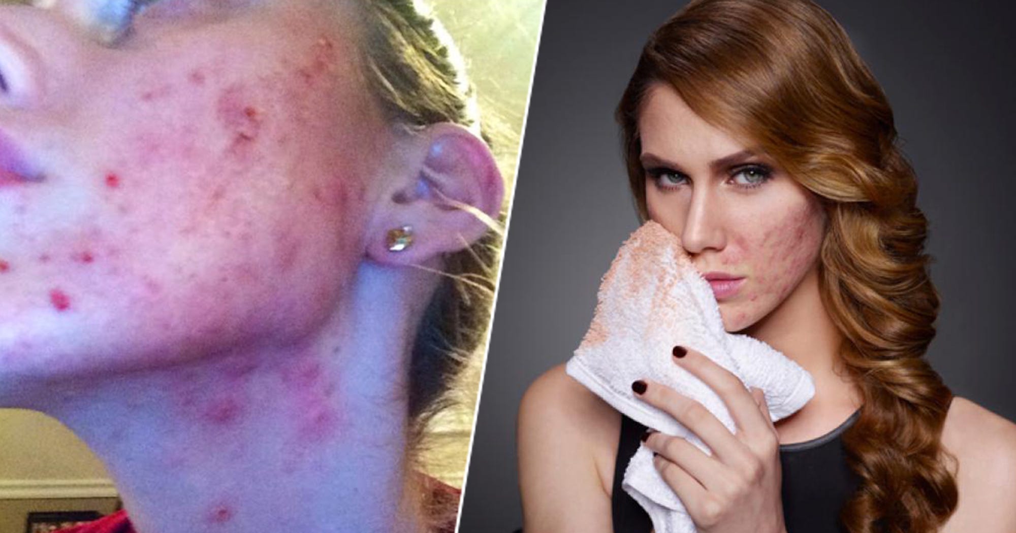 Cassandra Bankson Severe Acne Treatment Experience