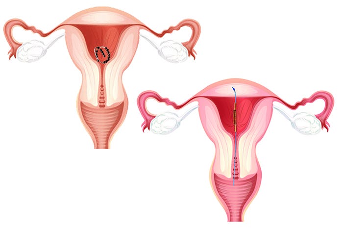 Erfahrungen Mit Gynefix Erfahrungen Mit Gynefix