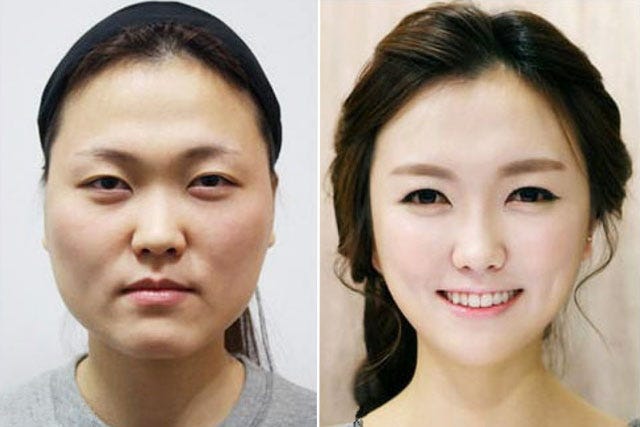 What It's Really Like To Get Extreme Plastic Surgery, From A