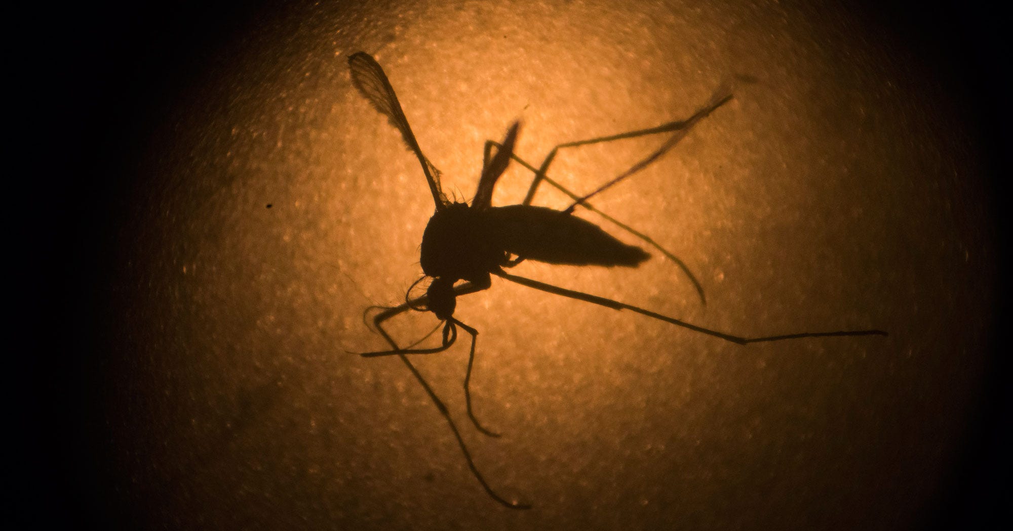 Zika, Baby With ZikaLinked Defects New Jersey(02)